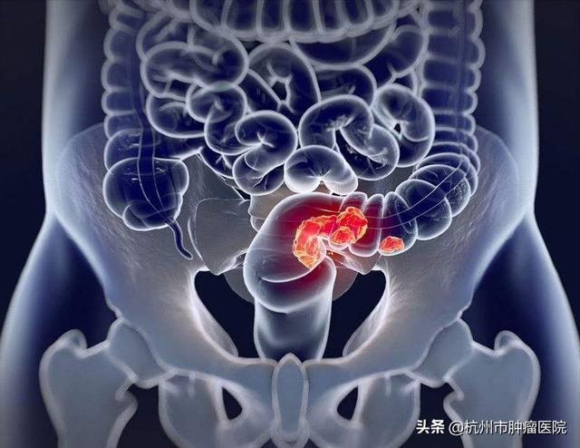 放置3个月的管子顺利拔除，大伯终于可以回家过年啦